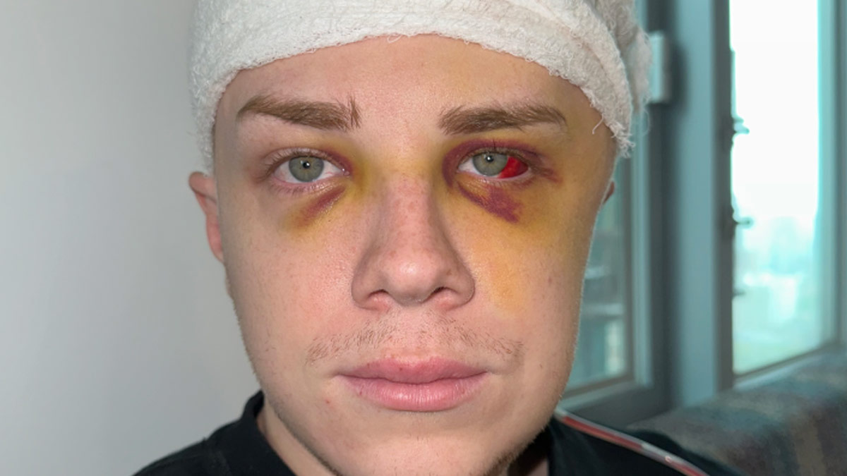 Doctors Remove A Part Of Skull Of US Man Thrice To Save Him From Staph Infection, Here’s All you Need To Know 